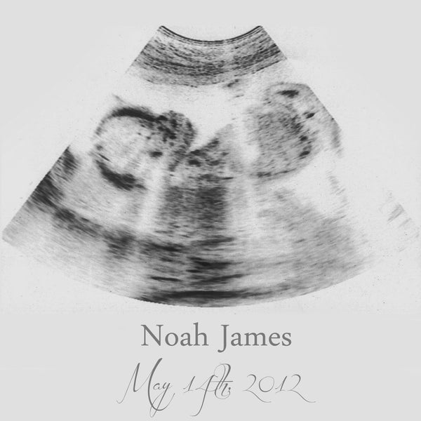 Custom Ultrasound Canvas - Canvas Vows